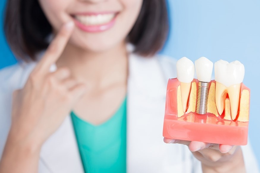 Рекомендації по догляду за зубними імплантами | ВІКНА. Новини Калуша та  Прикарпаття